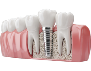dental implants